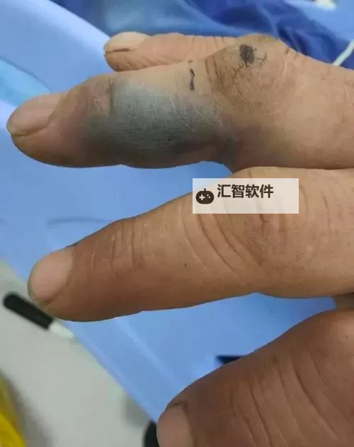 紫黑蘑菇横冲直撞：揭露红肿JH的神秘真相图1